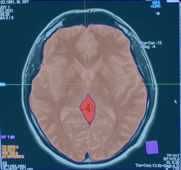 Medical scan segmentation applied to a brain MRI 